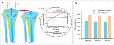 Biomechanical analysis of internal fixation system stability for tibial plateau fractures